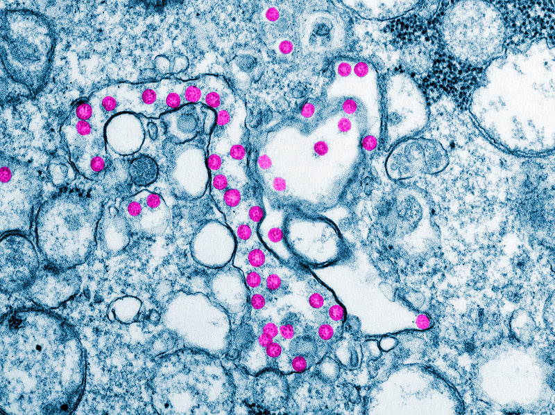 Microscopic image of SARS-CoV-2 virus attacking cells